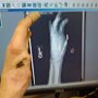 My Hand X-Rays